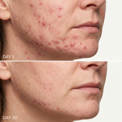 Solta Pro Face LED Therapy Mask